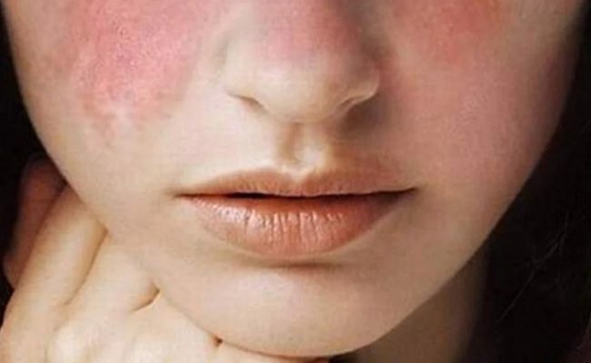 Lupus aposentadoria invalidez